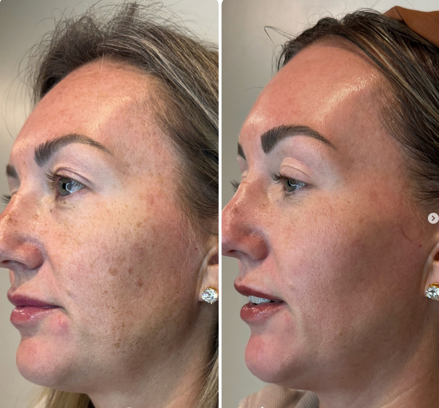 Square before and after laser result for BBL or MOXI