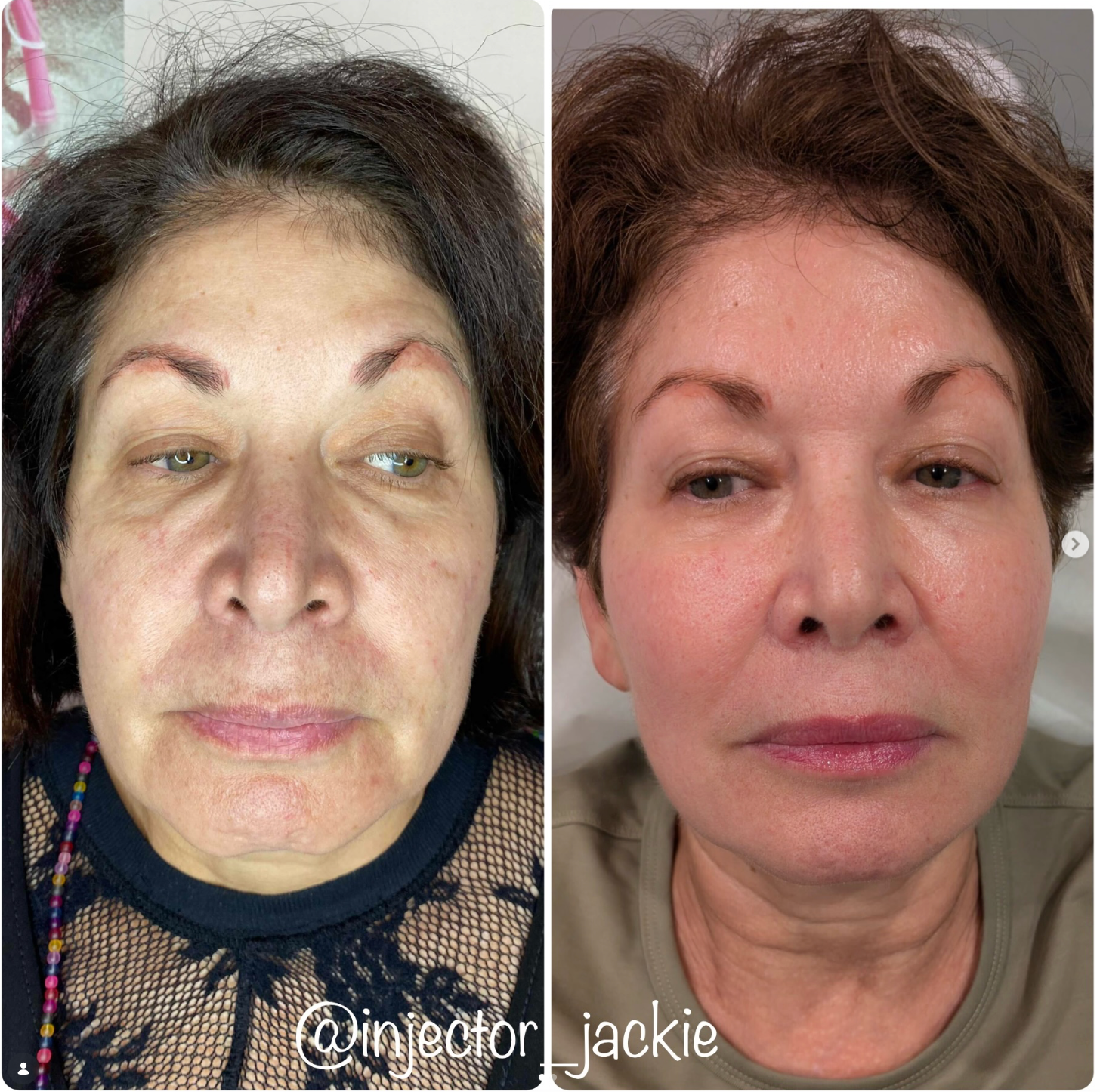 Before and after result showing what bio-stimulators, tox and good skin care can do